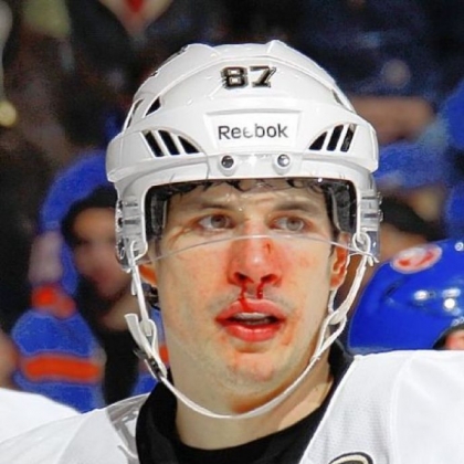 Sidney Crosby sports the effects under his nose of getting hit by the puck early in the second period Tuesday night. Crosby returned before the period.